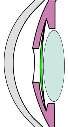 Image d'un œil avec un implant clippe